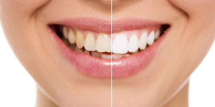 Vì sao răng bị ê buốt sau khi tẩy trắng?- Ảnh 1.