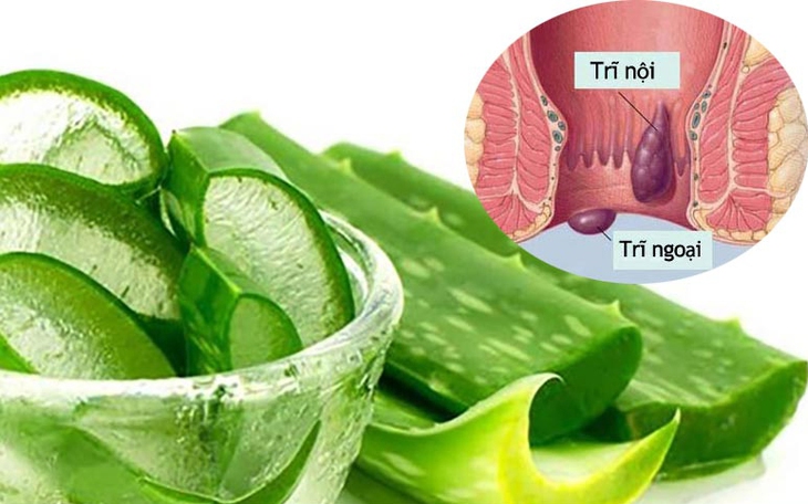 7 giải pháp tại nhà giảm đau nhanh do bệnh trĩ