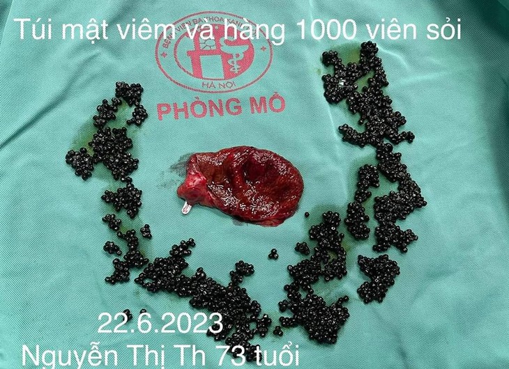 Hy hữu: Bệnh nhân 'chứa' hàng nghìn viên sỏi mật trong cơ thể - Ảnh 1.