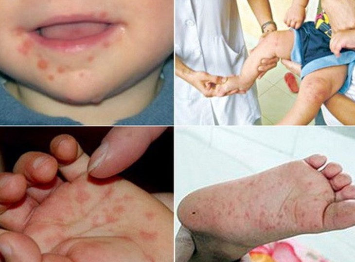 6.000 chai thuốc Immunoglobulin cung ứng cho các bệnh viện để điều trị bệnh nhân mắc tay chân miệng - Ảnh 1. 6.000 chai thuốc Immunoglobulin cung ứng cho các bệnh viện để điều trị bệnh nhân mắc tay chân miệng - Ảnh 1.