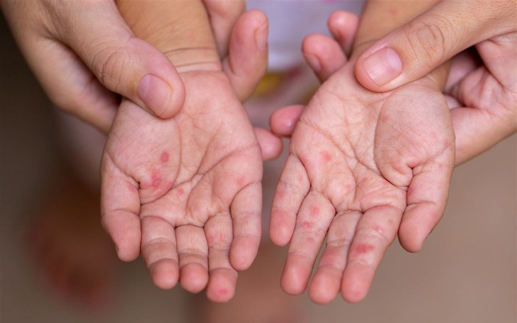 Có thể trị tay chân miệng tại nhà an toàn, tránh biến chứng?