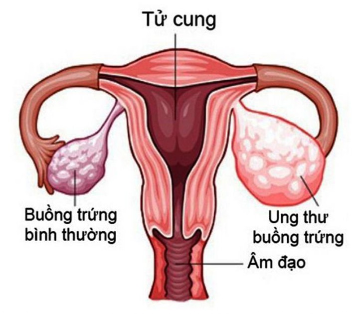 Những điều cần biết về phẫu thuật ung thư buồng trứng - Ảnh 2.