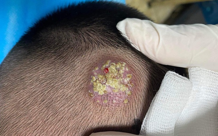 Nuôi chó, mèo làm thú cưng, 2 chị em cùng mắc bệnh lạ, phải cắt tóc trọc đầu