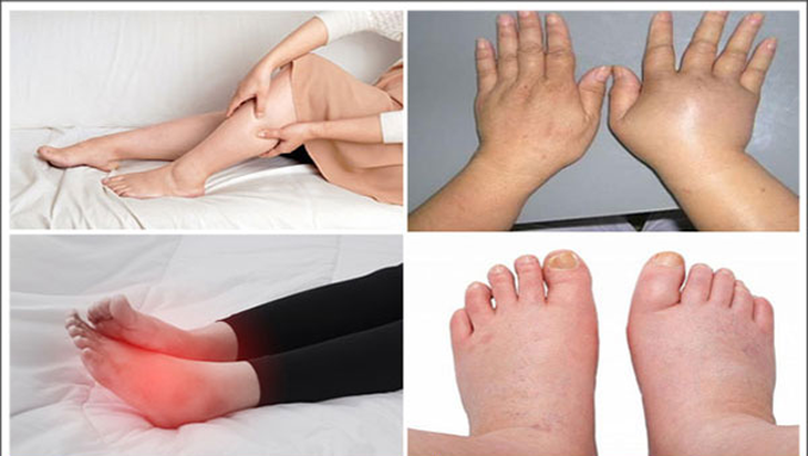 Phù là hiện tượng ứ nước trong các tổ chức dưới da hoặc ở các tạng của cơ thể. Phù là hiện tượng ứ nước trong các tổ chức dưới da hoặc ở các tạng của cơ thể.