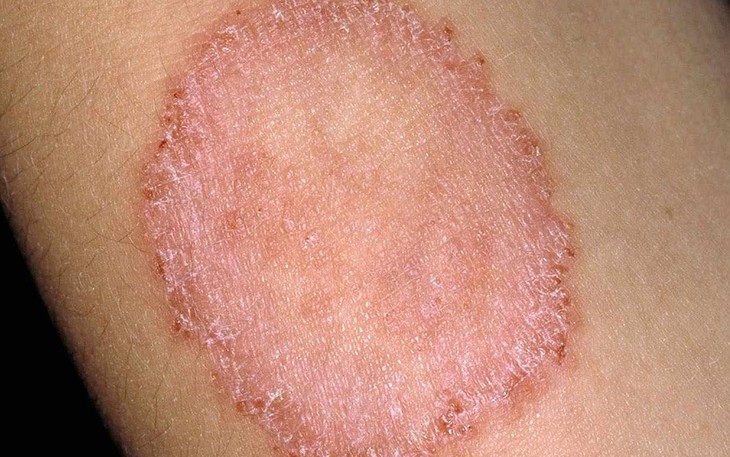 Bệnh hắc lào: Nguyên nhân và cách phòng ngừa