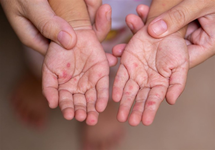 Cách chăm sóc vết loét khi trẻ bị tay chân miệng, có nên bôi xanh methylen? - Ảnh 1. Cách chăm sóc vết loét khi trẻ bị tay chân miệng, có nên bôi xanh methylen? - Ảnh 1.