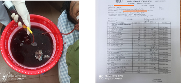 Nghiện rượu lâu năm, người đàn ông bị nôn ra 1 lít máu - Ảnh 1.