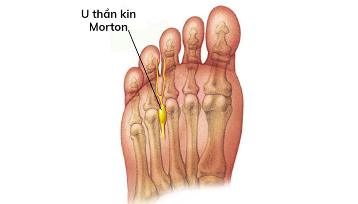 Đau ở bàn chân, tê ngón chân... cảnh giác với u dây thần kinh morton - Ảnh 1.