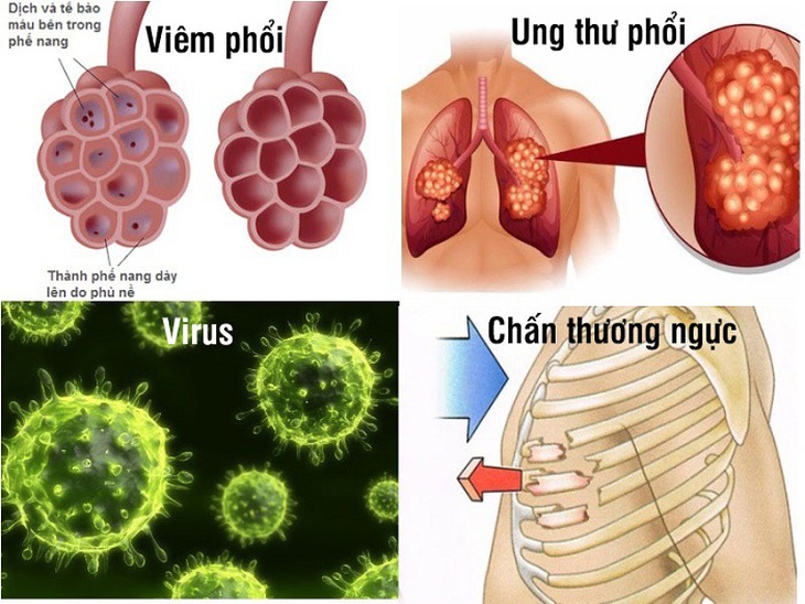 Tràn dịch màng phổi: Nguyên nhân, biểu hiện và điều trị - Ảnh 1.