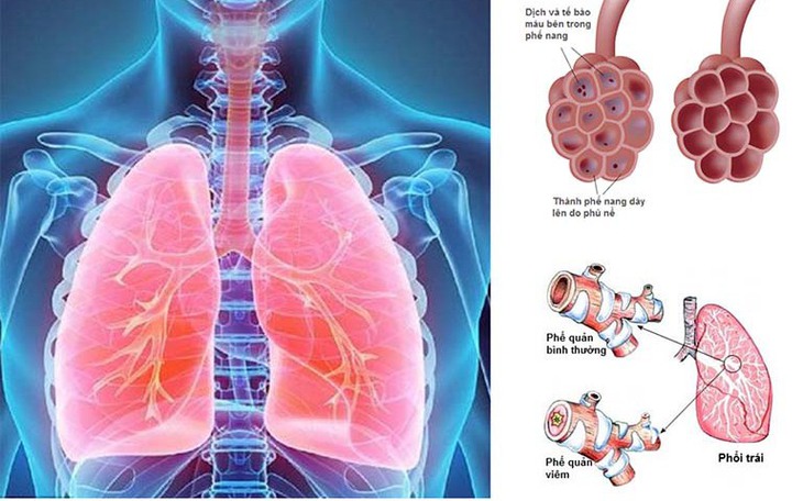 Ai dễ mắc viêm phổi, cần làm gì để chóng hồi phục?