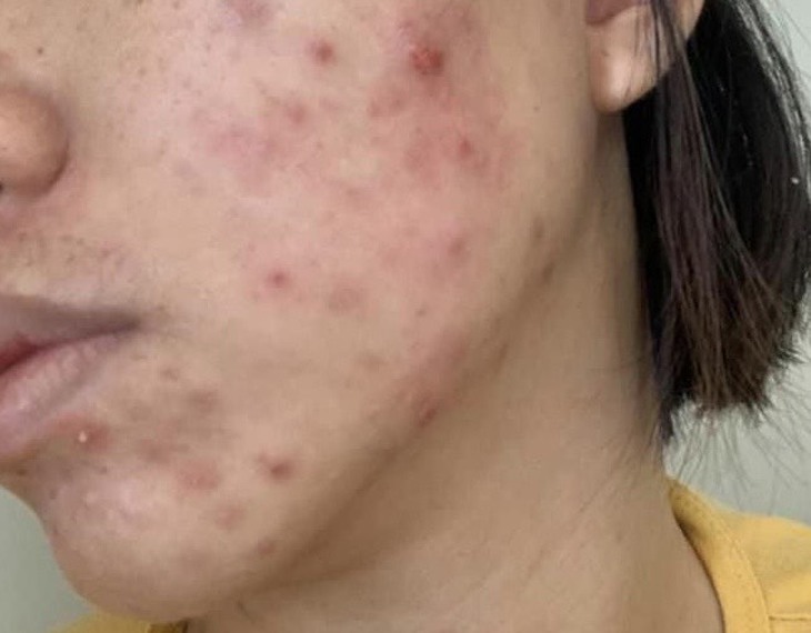 Nhiều nguy hại tiềm ẩn từ việc sử dụng mỹ phẩm không rõ nguồn gốc - Ảnh 1. Nhiều nguy hại tiềm ẩn từ việc sử dụng mỹ phẩm không rõ nguồn gốc - Ảnh 1.