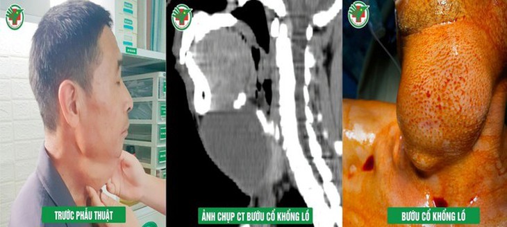 BVĐK TP Vinh: Phẫu thuật điều trị thành công trường hợp bướu cổ khổng lồ - Ảnh 1. BVĐK TP Vinh: Phẫu thuật điều trị thành công trường hợp bướu cổ khổng lồ - Ảnh 1.