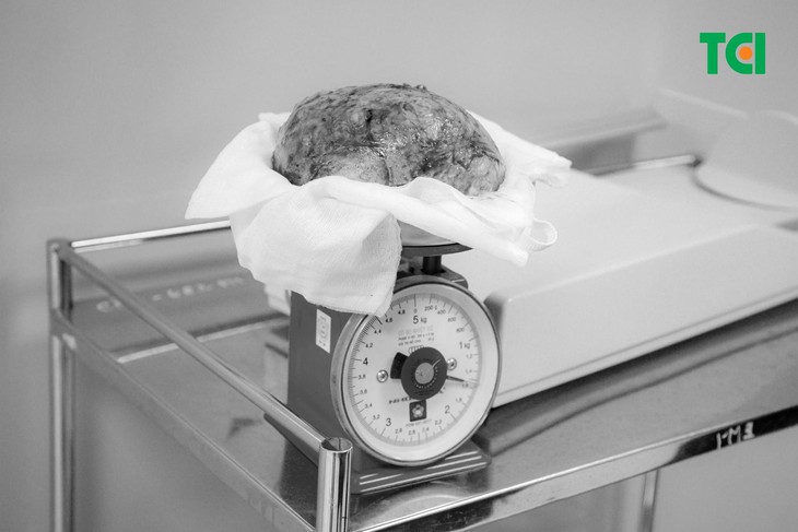 Kỳ tích: Bảo toàn thiên chức làm mẹ sau phẫu thuật khối u xơ nặng 1,5kg - Ảnh 3. Kỳ tích: Bảo toàn thiên chức làm mẹ sau phẫu thuật khối u xơ nặng 1,5kg - Ảnh 3.