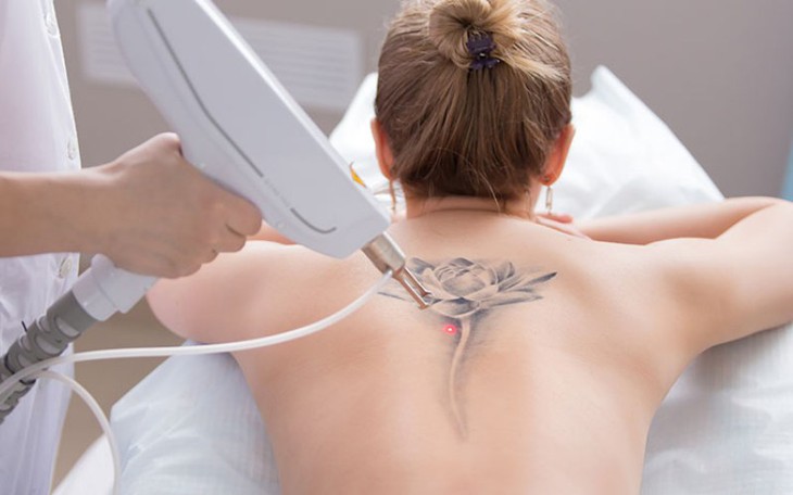 Xóa xăm bằng laser - Ảnh 1.