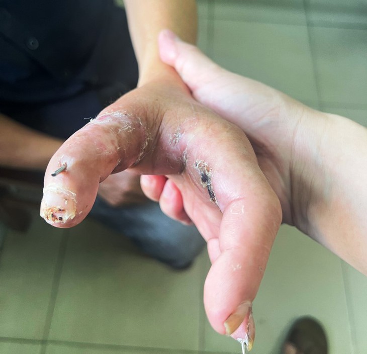 Mang ngón tay đứt lìa vào bệnh viện được các bác sĩ nối lại thành công - Ảnh 1. Mang ngón tay đứt lìa vào bệnh viện được các bác sĩ nối lại thành công - Ảnh 1.