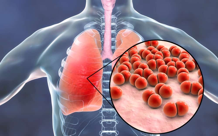 Dấu hiệu cho biết bạn đã mắc viêm phổi và cách xử trí