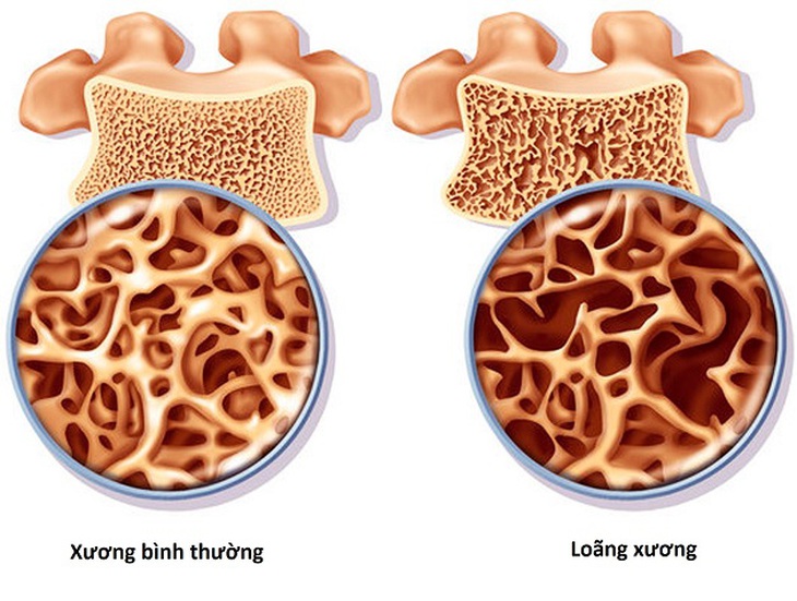 Có phải phụ nữ mãn kinh đều bị loãng xương không?- Ảnh 1.