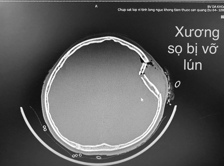 Ca mổ xuyên đêm cứu cháu bé 12 tuổi bị vỡ xương sọ - Ảnh 1.