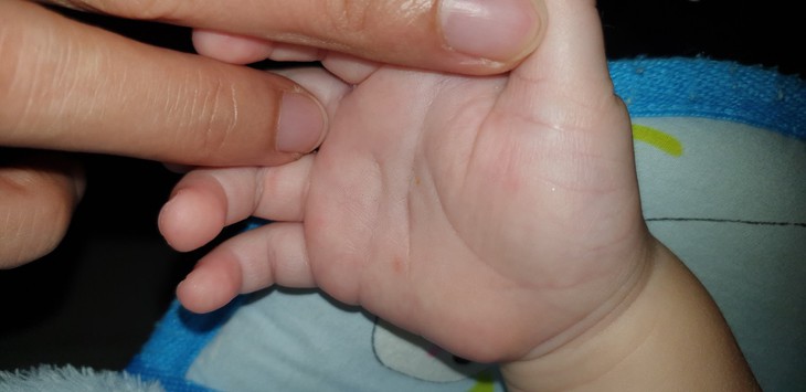 TP.HCM gia tăng các ca tay chân miệng nặng, cần cảnh giác với chủng virus có độc lực mạnh - Ảnh 2.