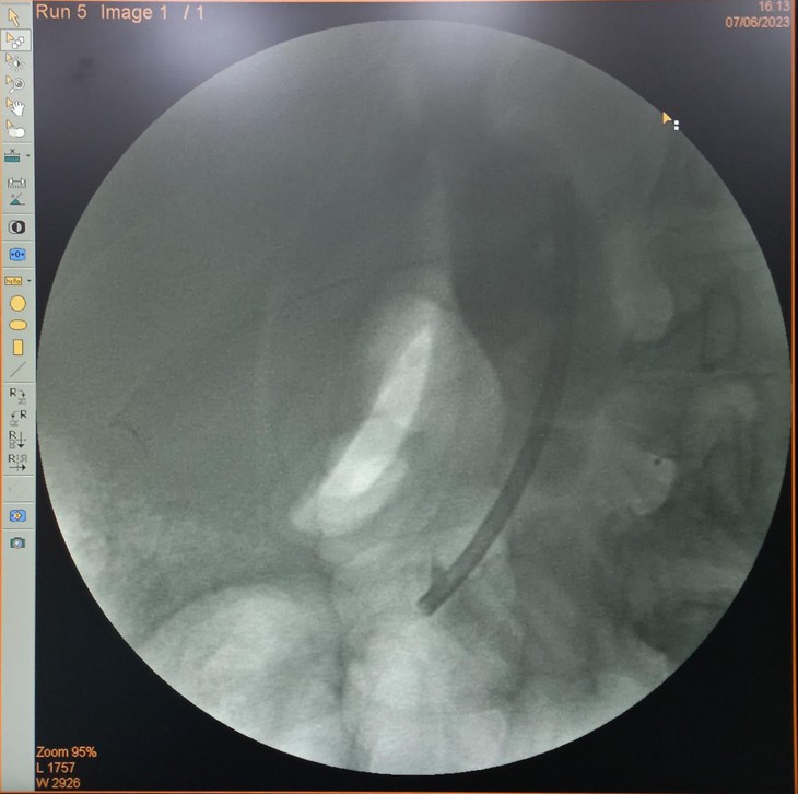 Nam bệnh nhân bỏ quên stent trong đường mật suốt 2 năm - Ảnh 2. Nam bệnh nhân bỏ quên stent trong đường mật suốt 2 năm - Ảnh 2.