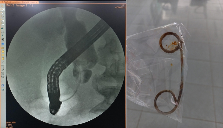 Nam bệnh nhân bỏ quên stent trong đường mật suốt 2 năm - Ảnh 1. Nam bệnh nhân bỏ quên stent trong đường mật suốt 2 năm - Ảnh 1.