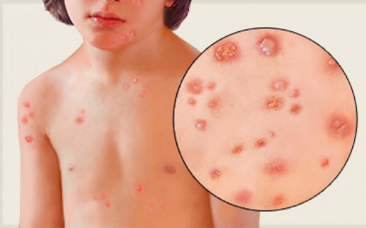 Bị thủy đậu sẽ gặp những biến chứng nào?