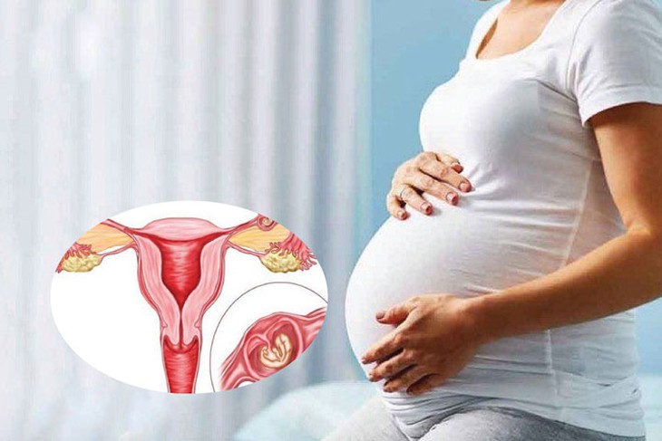 Người phụ nữ 34 tuổi bị sốc mất máu do khối chửa ngoài tử cung vỡ - Ảnh 1. Người phụ nữ 34 tuổi bị sốc mất máu do khối chửa ngoài tử cung vỡ - Ảnh 1.