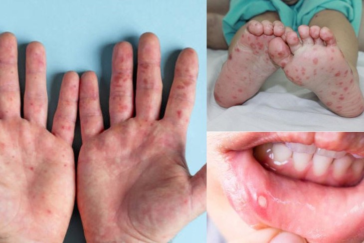 Ca mắc bệnh tay chân miệng ở Nam Trung Bộ tăng nhanh, cấp bách phòng bệnh - Ảnh 2.
