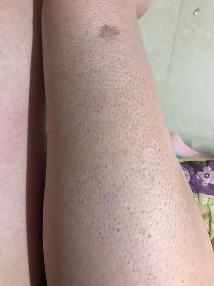 Dày sừng nang lông và cách điều trị - Ảnh 1. Dày sừng nang lông và cách điều trị - Ảnh 1.