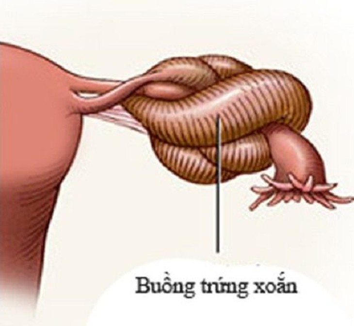 5 điều phụ nữ nên biết về xoắn buồng trứng để không ảnh hưởng đến khả năng sinh sản - Ảnh 2. 5 điều phụ nữ nên biết về xoắn buồng trứng để không ảnh hưởng đến khả năng sinh sản - Ảnh 2.