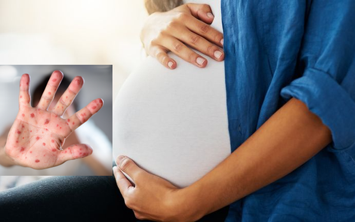 Thai phụ tiếp xúc với trẻ nhỏ mắc bệnh tay chân miệng có nguy hiểm không?