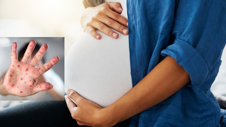 Thai phụ tiếp xúc với trẻ nhỏ mắc bệnh tay chân miệng có nguy hiểm không? - Ảnh 2. Thai phụ tiếp xúc với trẻ nhỏ mắc bệnh tay chân miệng có nguy hiểm không? - Ảnh 2.