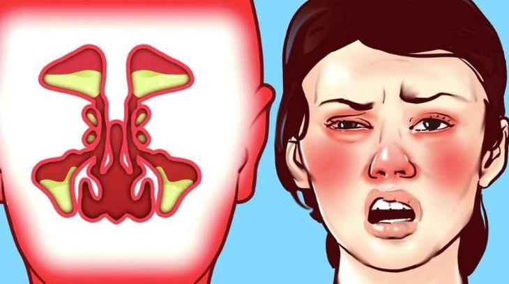 Thuốc gì trị ngạt mũi? - Ảnh 1.