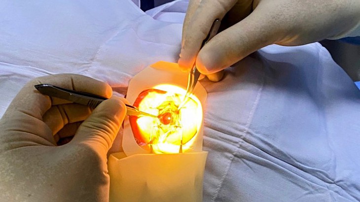 Hải Phòng cứu vãn thị lực ca bệnh bị vỡ nhãn cầu mắt trái - Ảnh 2.