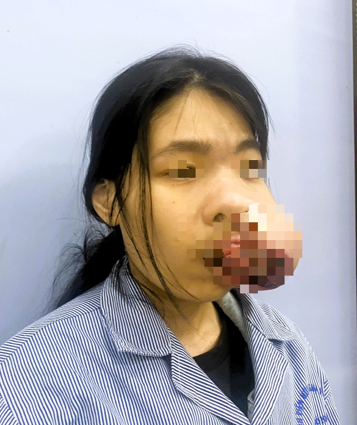 Hải Phòng: Phẫu thuật và tạo hình phục hồi khuôn mặt cho ca bệnh u men xương hàm - Ảnh 1. Hải Phòng: Phẫu thuật và tạo hình phục hồi khuôn mặt cho ca bệnh u men xương hàm - Ảnh 1.