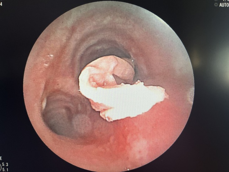 Nội soi phế quản lấy dị vật khăn giấy dài 15cm - Ảnh 1.
