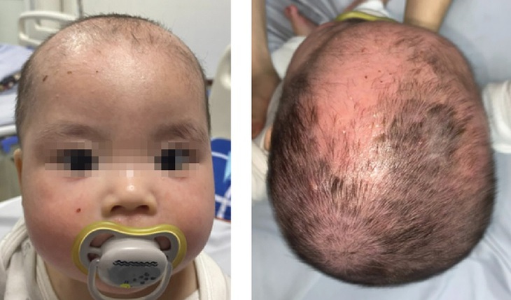 Tắm lá, bé trai bong tróc toàn bộ da mặt và đầu - Ảnh 3.