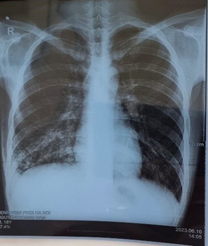 Những điều cần biết về viêm phổi cộng đồng do vi khuẩn Mycoplasma - Ảnh 3.
