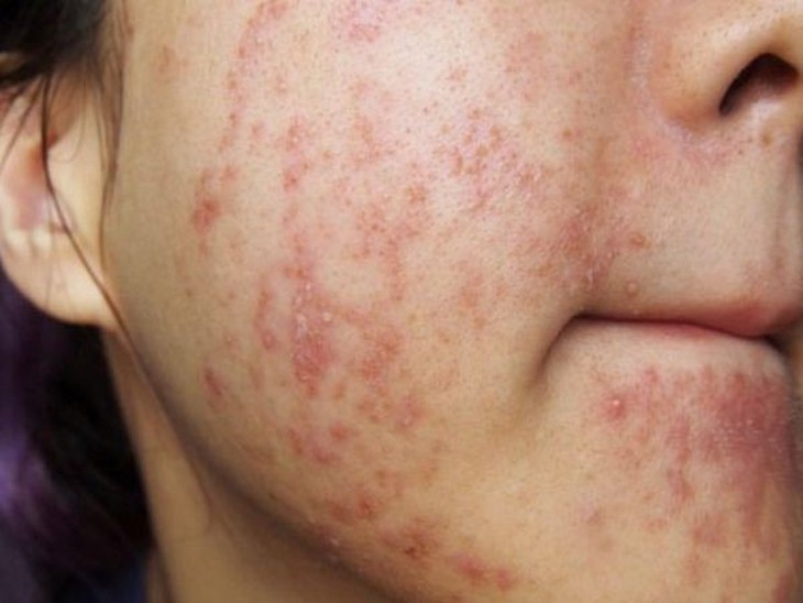 Bí kíp xử lý mụn viêm tuổi dậy thì hiệu quả - Ảnh 1.