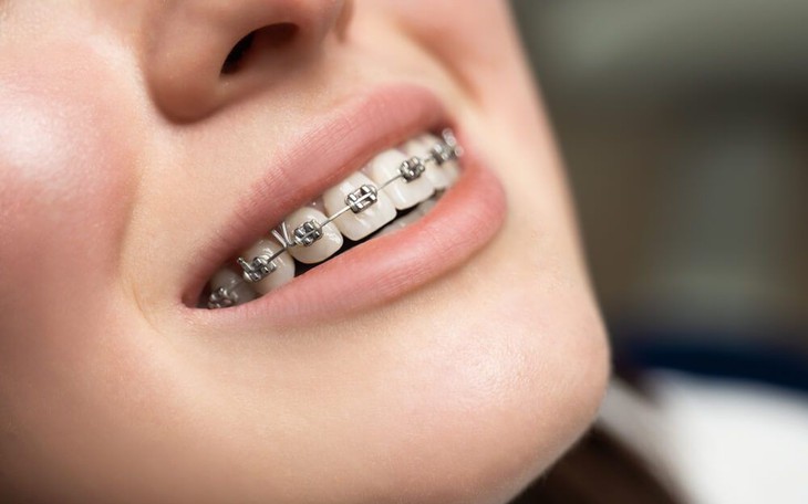 11 quan niệm sai lầm về niềng răng