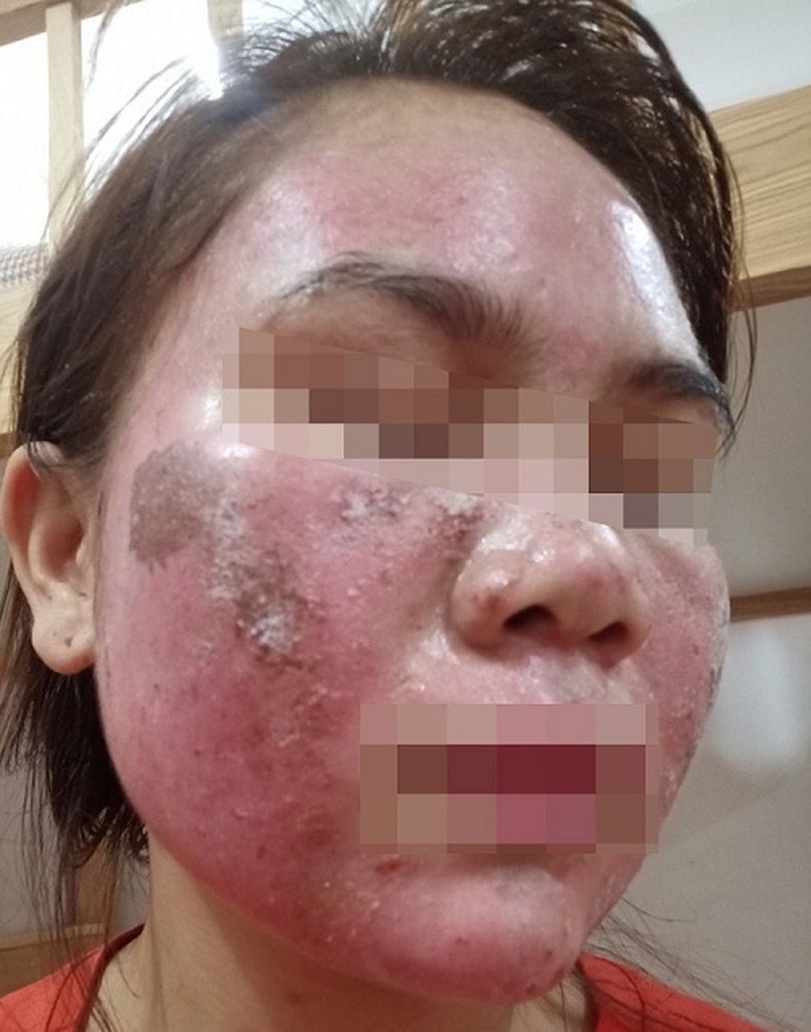 Trẻ hóa làn da bằng peel, nhiều người hoảng hốt thấy da bong tróc như da rắn, bỏng rát, ửng đỏ - Ảnh 1. Trẻ hóa làn da bằng peel, nhiều người hoảng hốt thấy da bong tróc như da rắn, bỏng rát, ửng đỏ - Ảnh 1.
