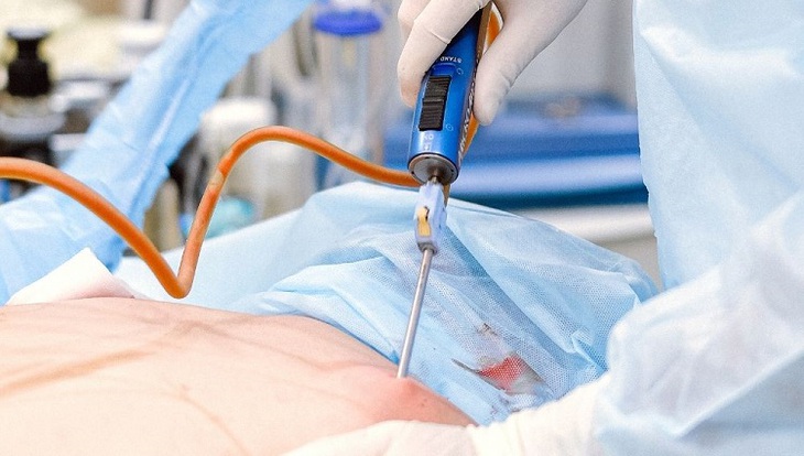 Cẩn trọng tránh "tiền mất tật mang" khi hút mỡ bụng tại các cơ sở không uy tín - Ảnh 2.