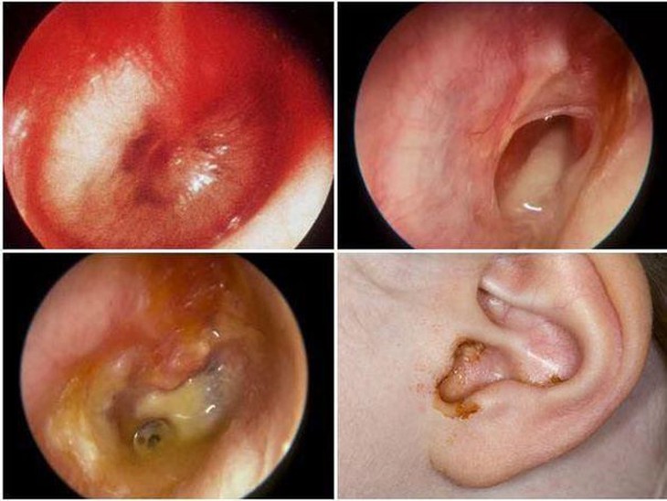 Viêm tai giữa tái đi tái lại, nguyên nhân do đâu? - Ảnh 3.
