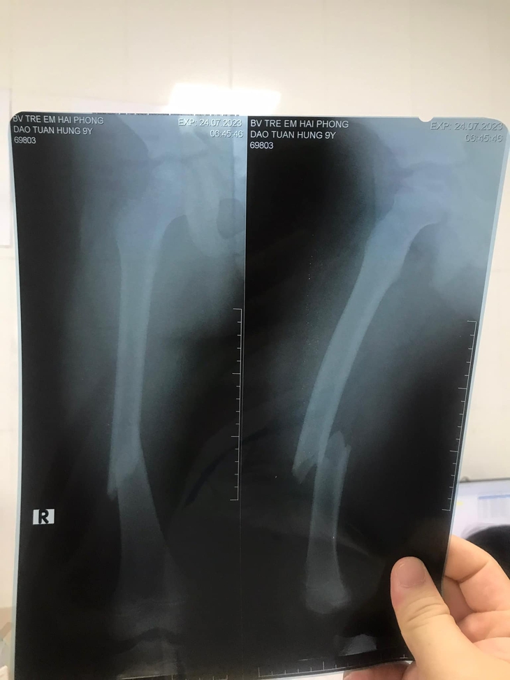 Bệnh viện Trẻ em Hải Phòng mổ cấp cứu thành công 2 ca là chị em ruột trong vụ tai nạn giao thông nghiêm trọng - Ảnh 2. Bệnh viện Trẻ em Hải Phòng mổ cấp cứu thành công 2 ca là chị em ruột trong vụ tai nạn giao thông nghiêm trọng - Ảnh 2.
