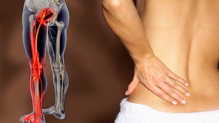4 thói quen cần tránh khiến đau thần kinh tọa thêm trầm trọng - Ảnh 1.