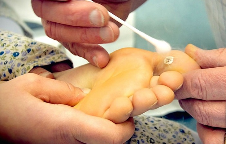 Mặc dù mụn cóc lòng bàn chân có thể tự biến mất nhưng không nên chủ quan.