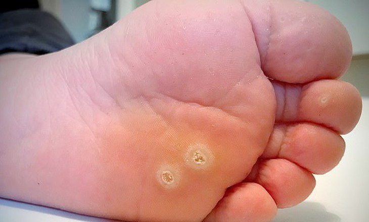 Mụn cóc ở mặt lòng bàn chân là một nhiễm trùng da do virus HPV phổ biến ở mặt lòng bàn chân của bạn.