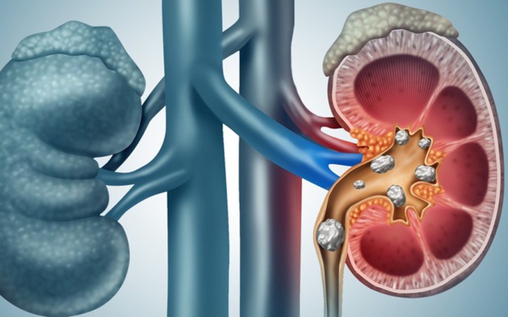 Sỏi thận: Nguyên nhân, dấu hiệu và cách điều trị