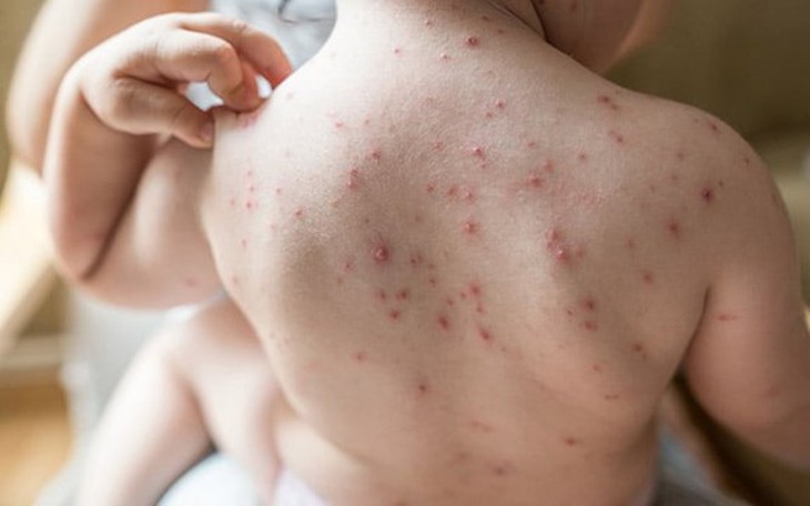 Hà Nội: Số ca mắc thủy đậu, sốt xuất huyết đều tăng