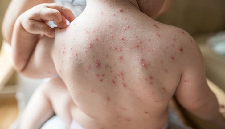 Hà Nội: Số ca mắc thủy đậu, sốt xuất huyết đều tăng - Ảnh 1.